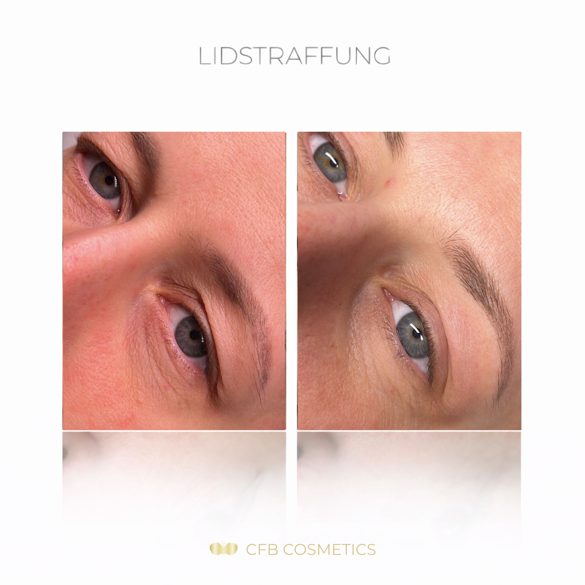 Aparato PlasCom® Plasma Pen para el reafirmamiento y rejuvenecimiento de la piel de CFB Cosmetics®