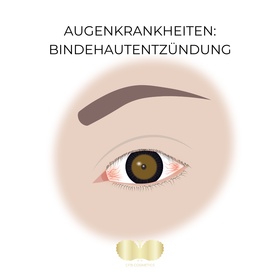Finger weg: keine Wimpern Extensions bei diesen Augenkrankheiten - CFB Cosmetics