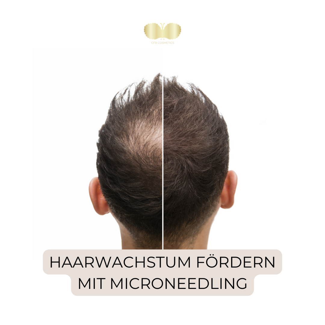 Haarwachstum fördern und verdichten mit Microneedling / Nanoneedling - CFB Cosmetics