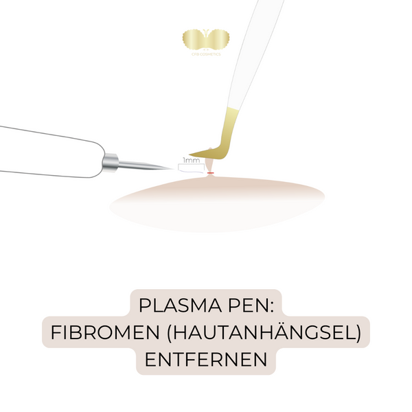 Eliminación de fibromas con el Plascom® Plasma Pen: una solución poco invasiva