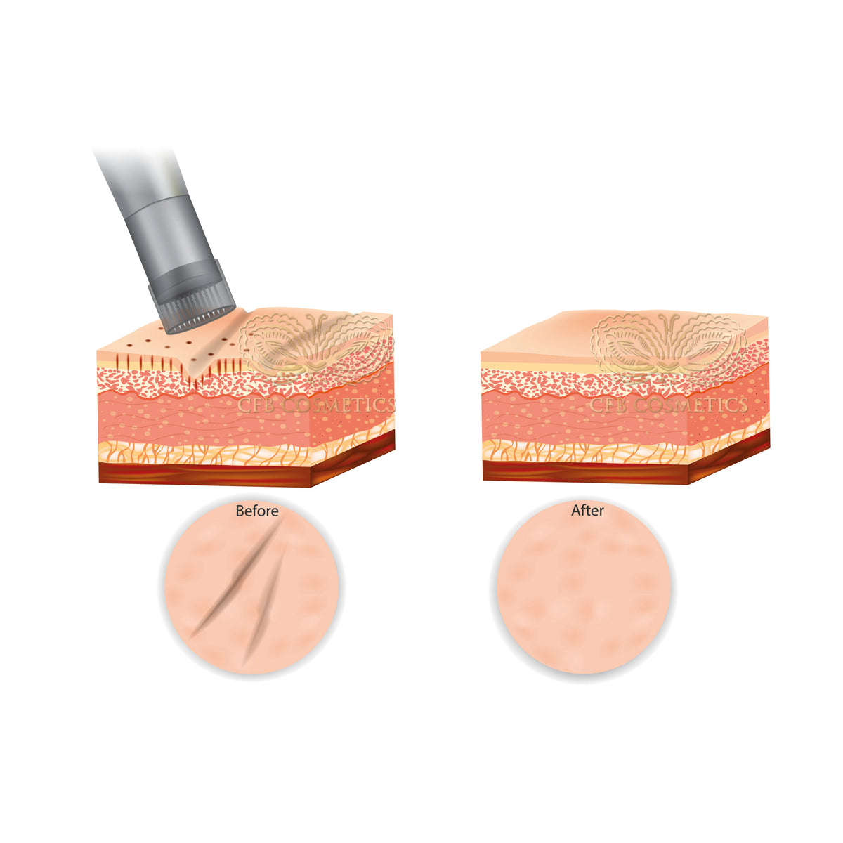 Sérum hialurónico de 10 ml para BB Glow y microagujas de CFB Cosmetics®