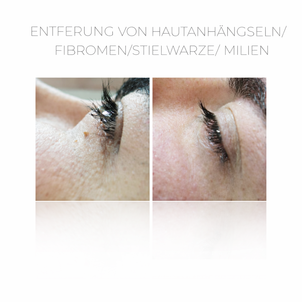 PlasCom® Plasma Pen Gerät für Hautstraffung & Verjüngung CFB Cosmetics®