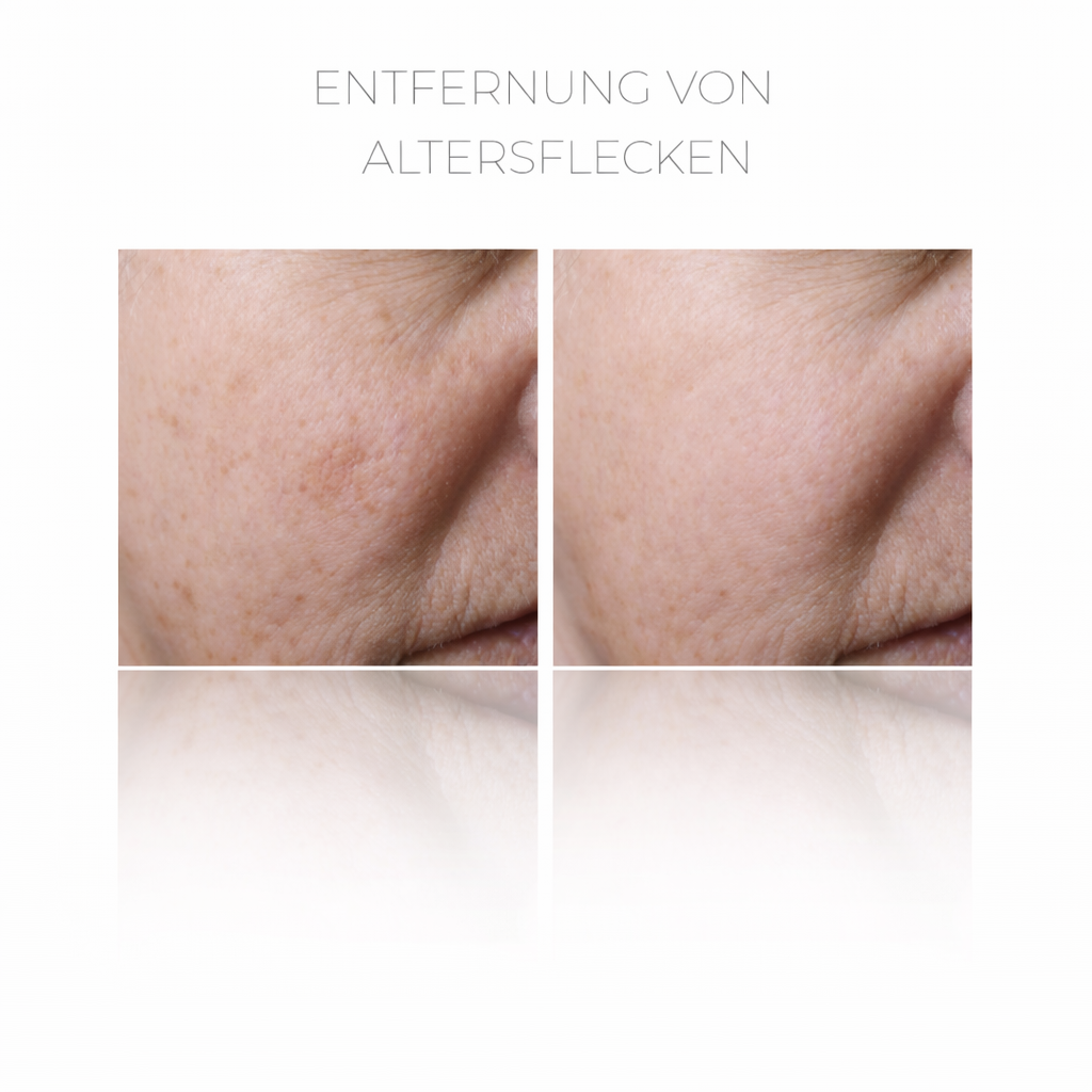 PlasCom® Plasma Pen Gerät für Hautstraffung & Verjüngung CFB Cosmetics®